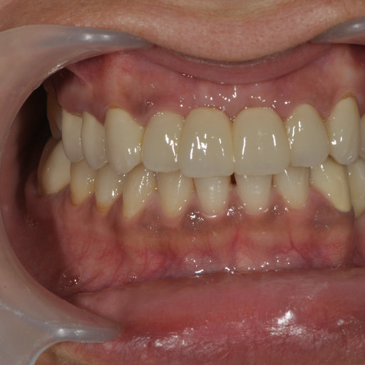 After image