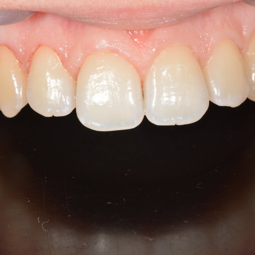 After image
