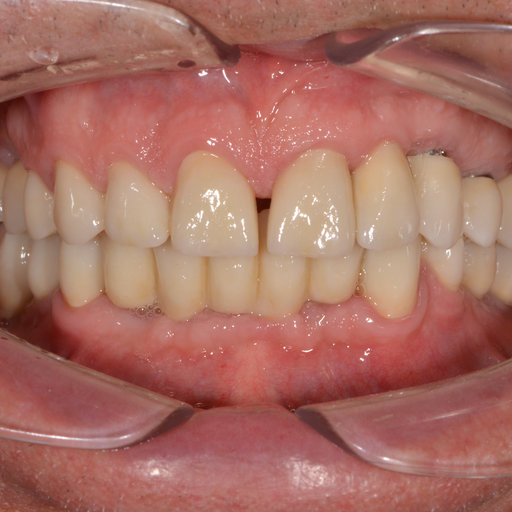 After image