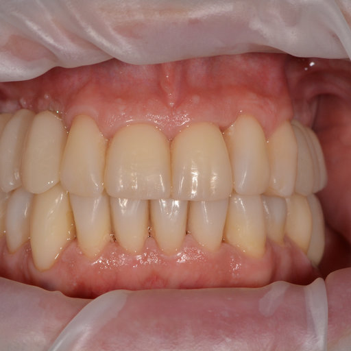 After image