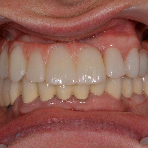 After image
