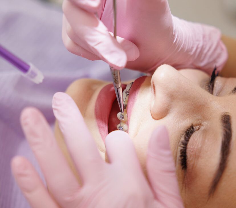 aparat dentar Ambra